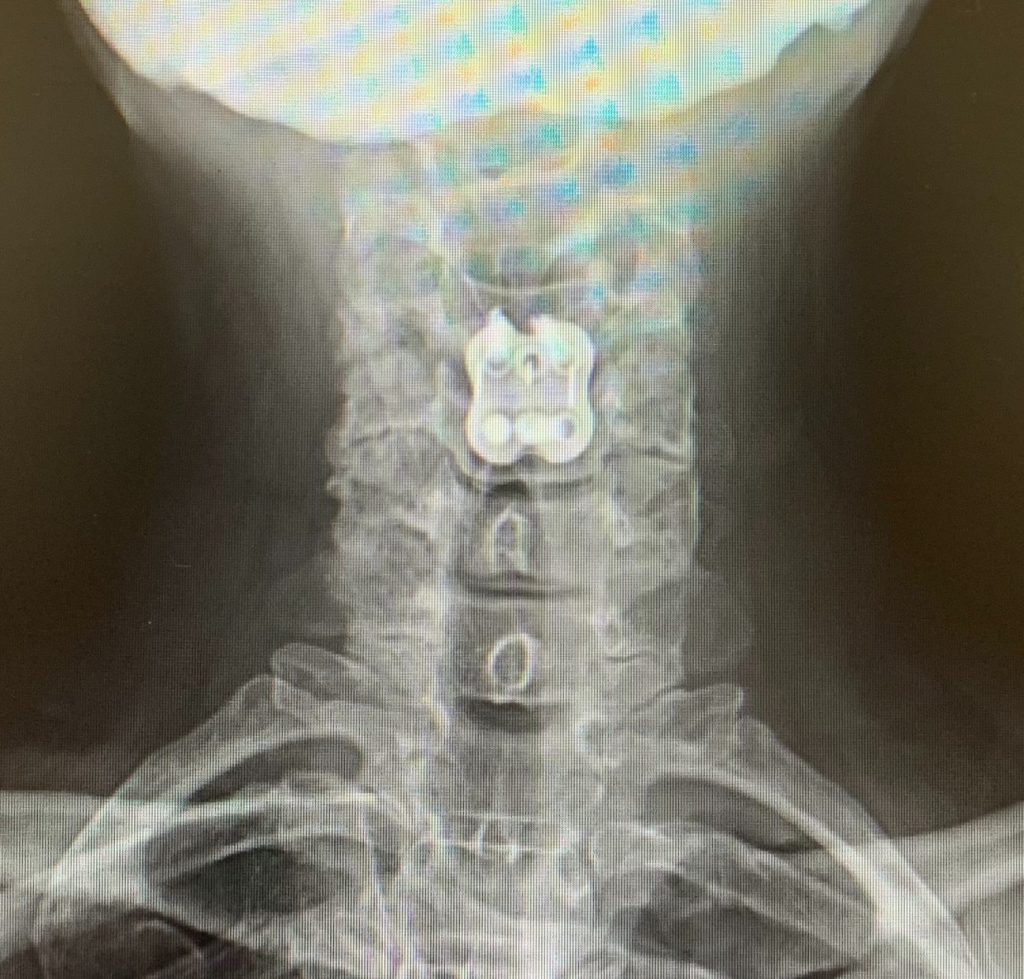 High Blood Pressure, Hormones, and Another&nbsp;Surgery